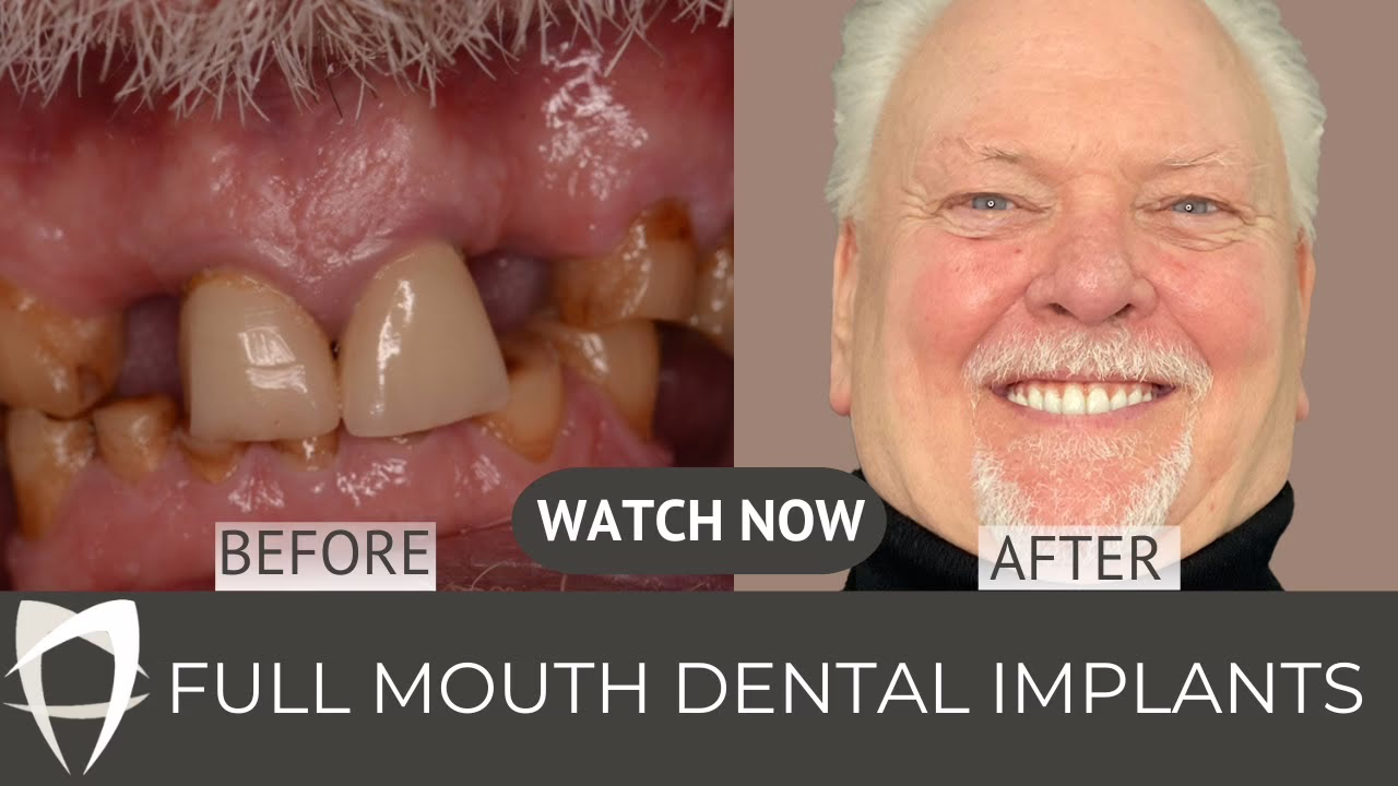 Robert Luke describing his All-on-4 dental implant treatment at London Dental Specialists