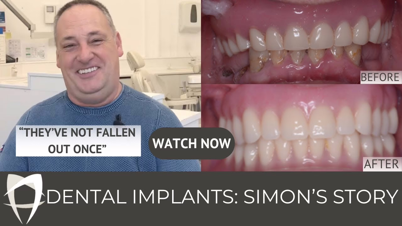 Simon's dental implant story, before and after