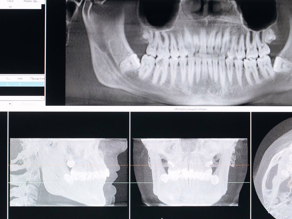 Panoramic x-ray and CBCT slices on screen