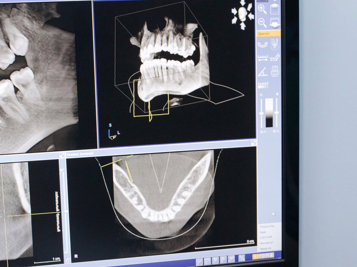 A 3D CBCT scan of the jaw on a monitor