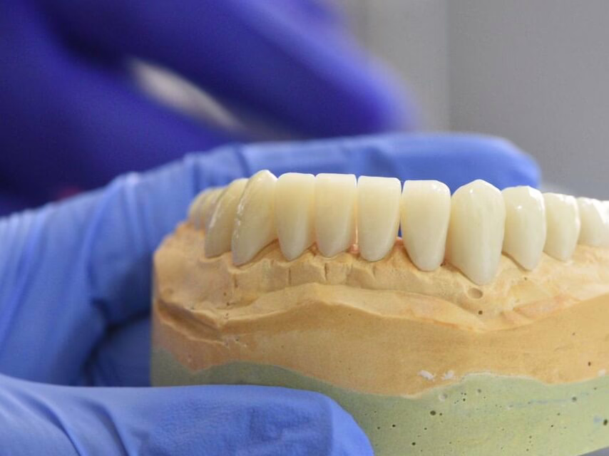 Plaster model with wax-up crowns