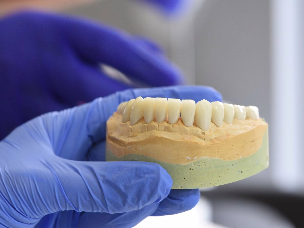 Plaster model with wax-up crowns