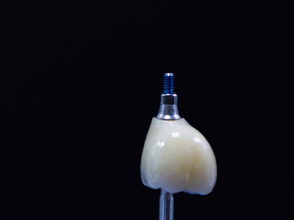 An implant crown on its abutment, held in a gloved hand