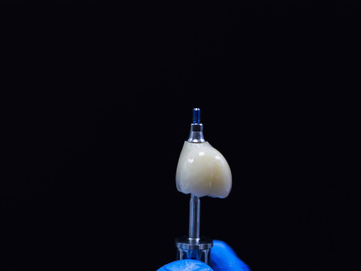 An implant crown on its abutment, held in a gloved hand