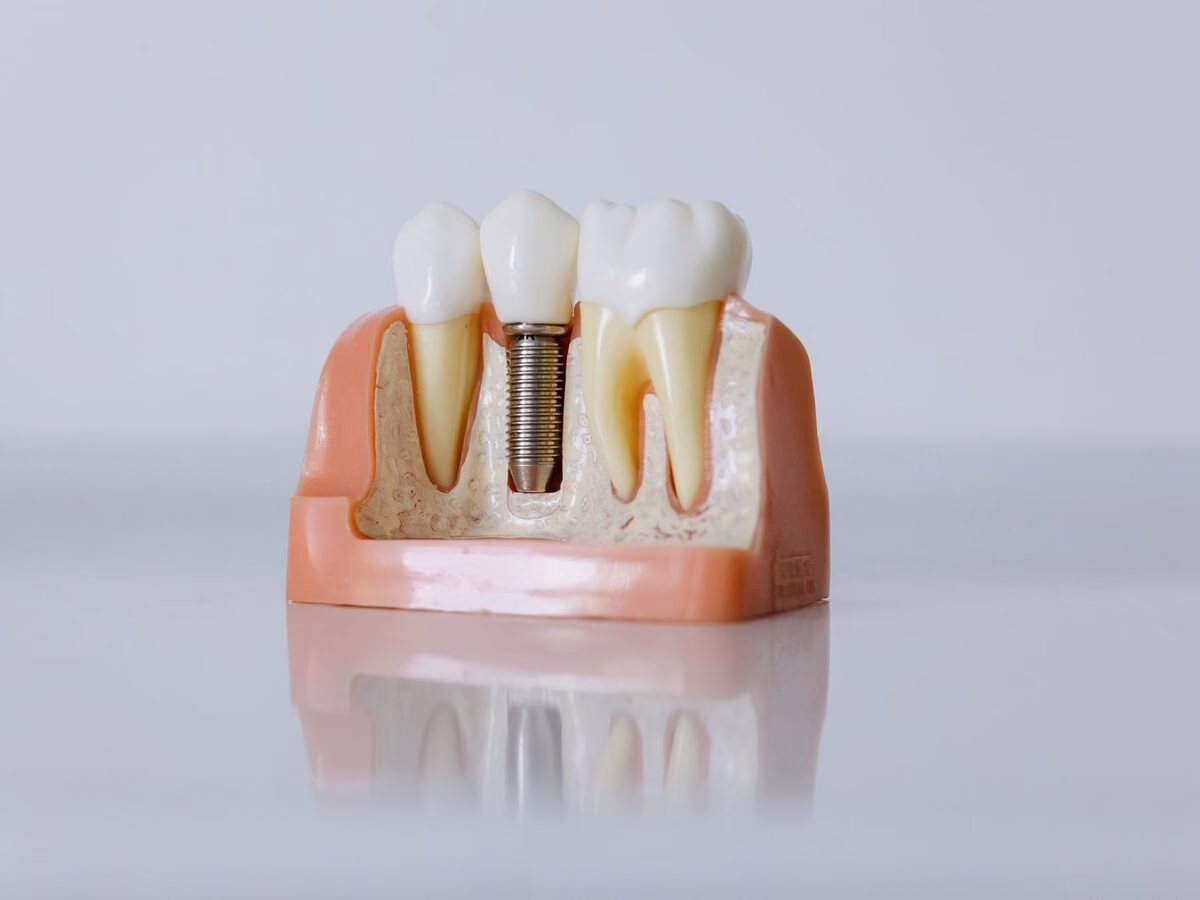 Cross-section model of a dental implant with its abutment and crown