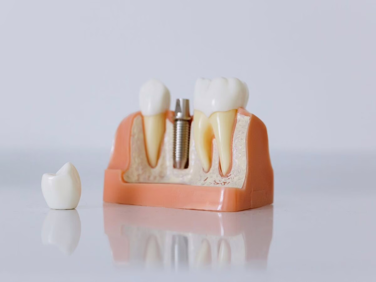 A dental implant model with a separate crown