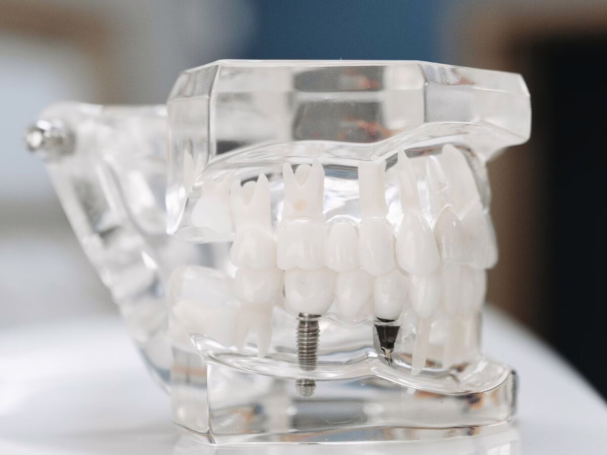 A clear dental model with a single implant
