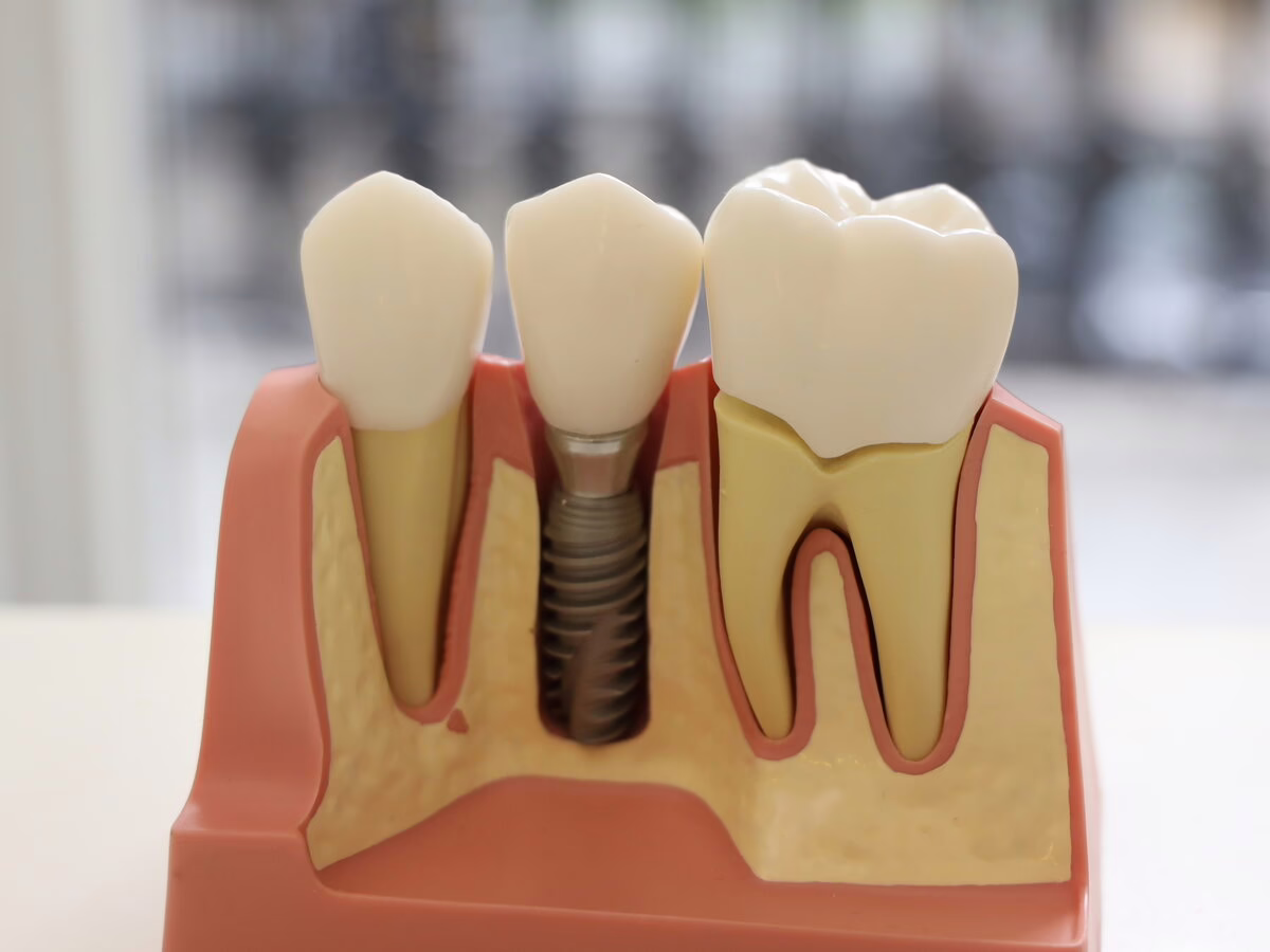 Dental implant model showing the implant, abutment and crown