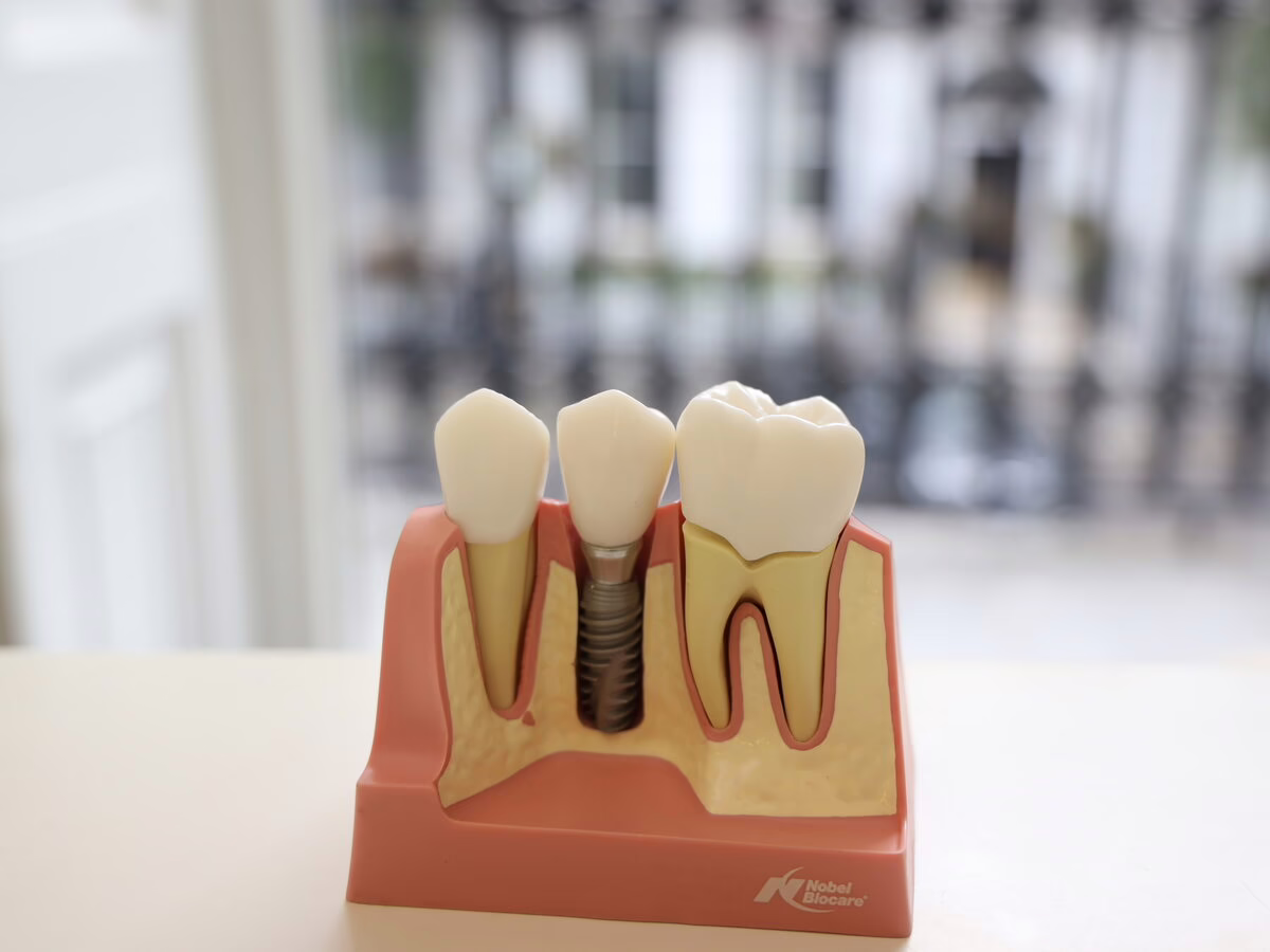 Dental implant model showing the implant, abutment and crown