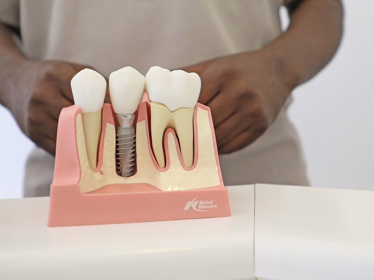 Dental implant model showing the implant, abutment and crown