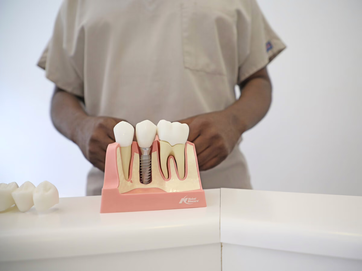 Dental implant model showing the implant, abutment and crown