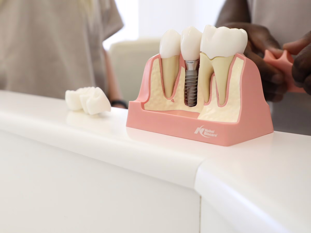 Dental implant model showing implants and crowns