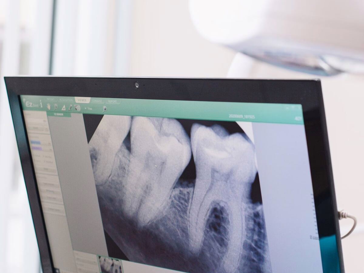 A dental x-ray of a single tooth on a laptop