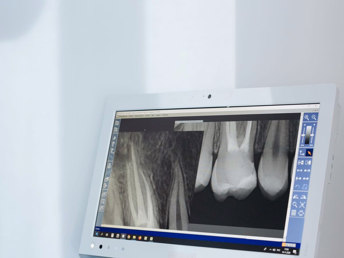 X-rays of single teeth and their roots on a monitor