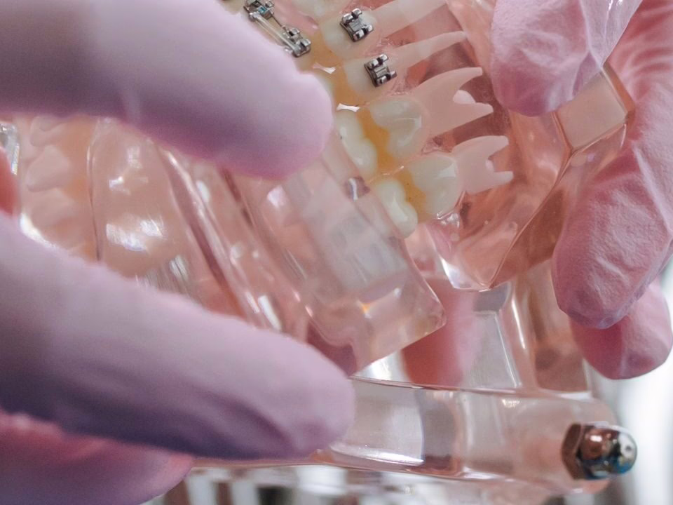 Gloved hands holding a model with clear braces