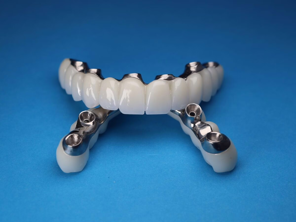 A full-arch implant bridge on a titanium bar