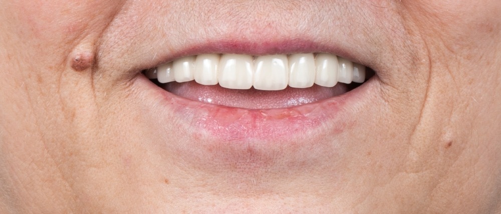 After treatment, case 2: a missing front tooth replaced with a dental implant, in a patient with diabetes