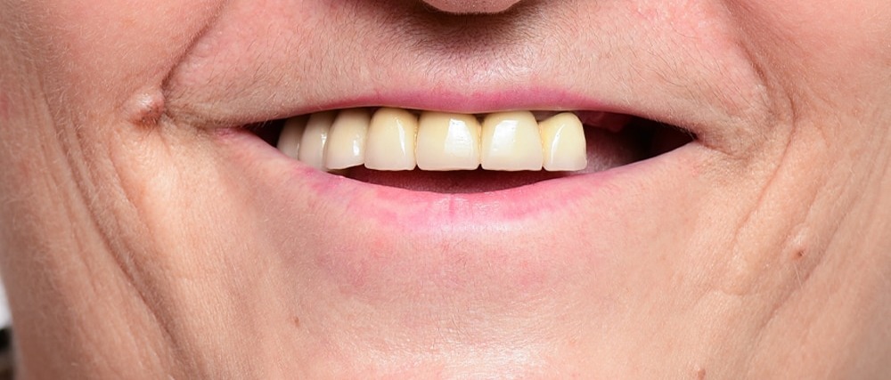 Before treatment, case 2