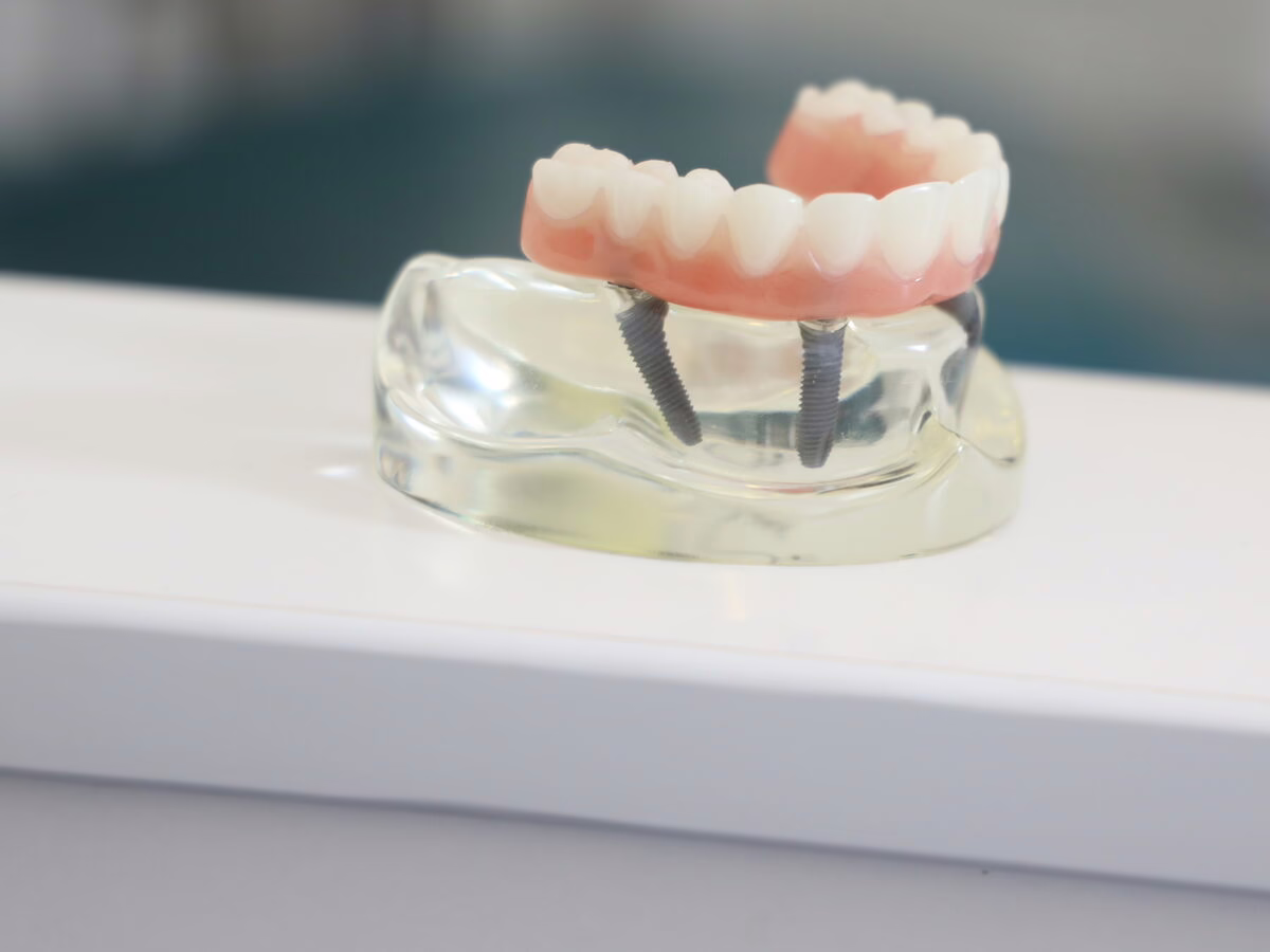 Model of a denture secured on dental implants