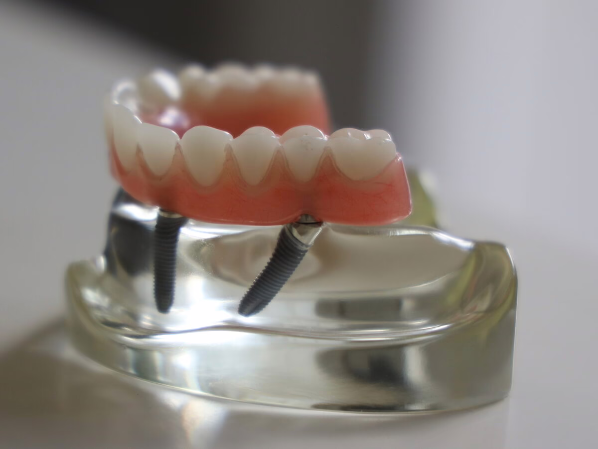 Model of a denture secured on dental implants