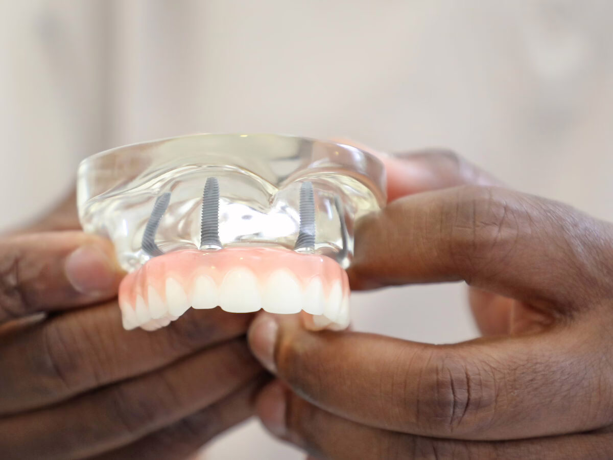 Model of a denture secured on dental implants