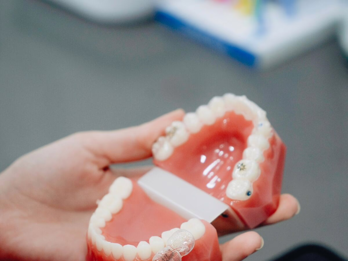 An orthodontic retainer on a dental model