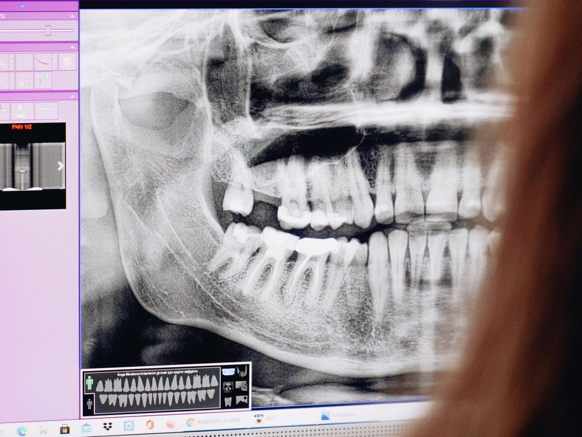 A panoramic x-ray showing dental implants