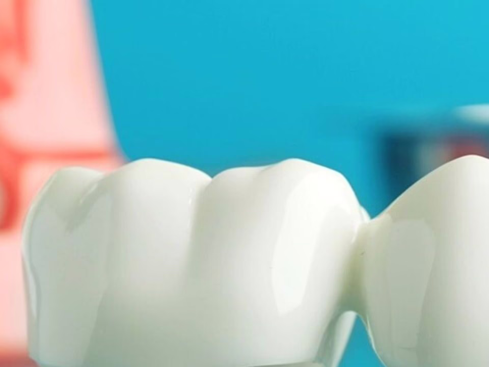 A three-unit porcelain dental bridge