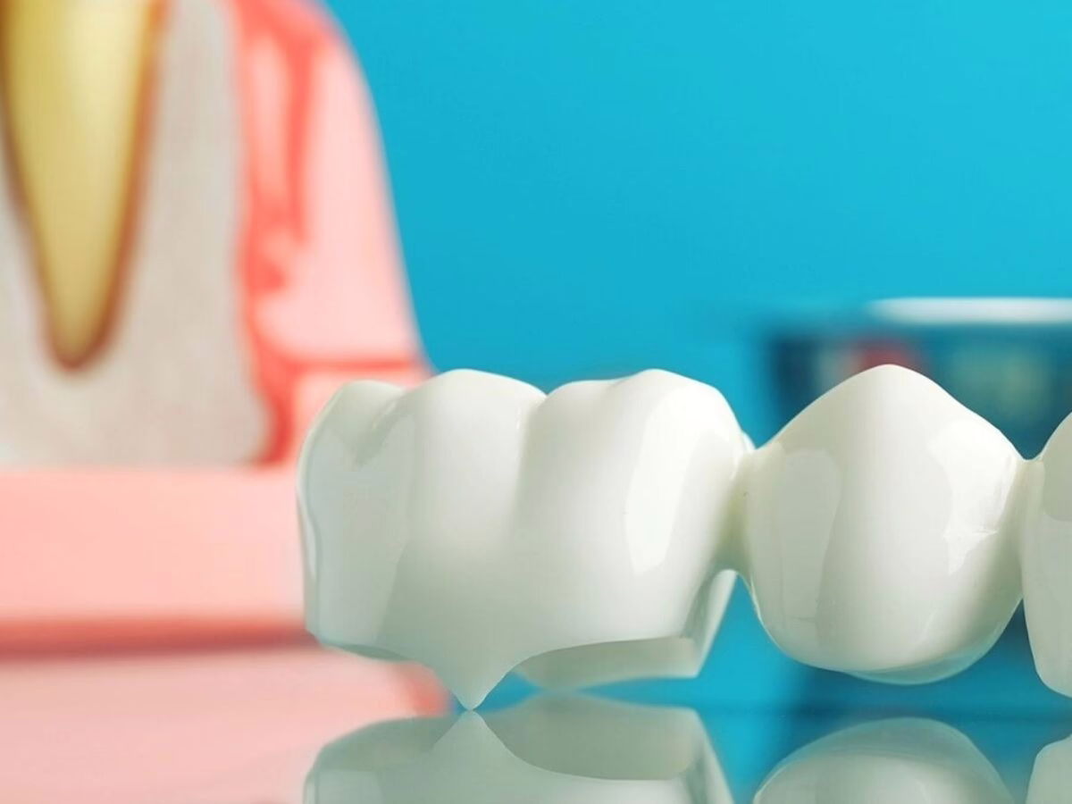 A three-unit porcelain dental bridge